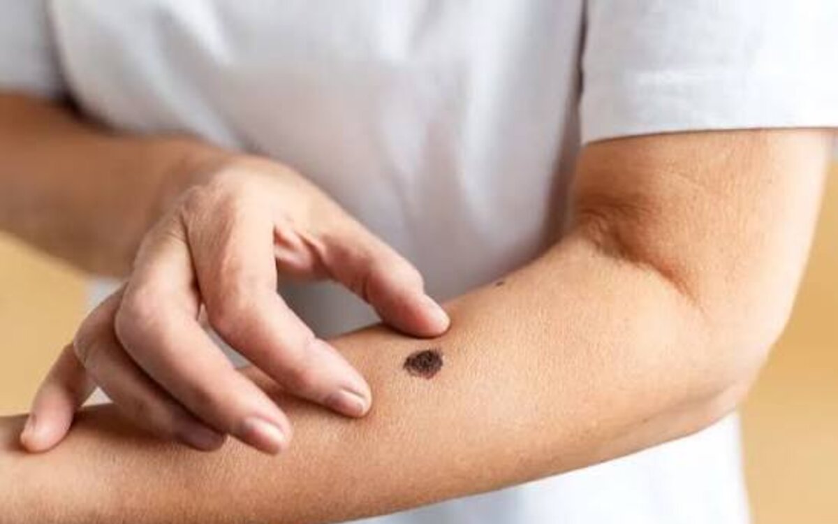 13 de junio: Día Mundial del Cáncer de Piel